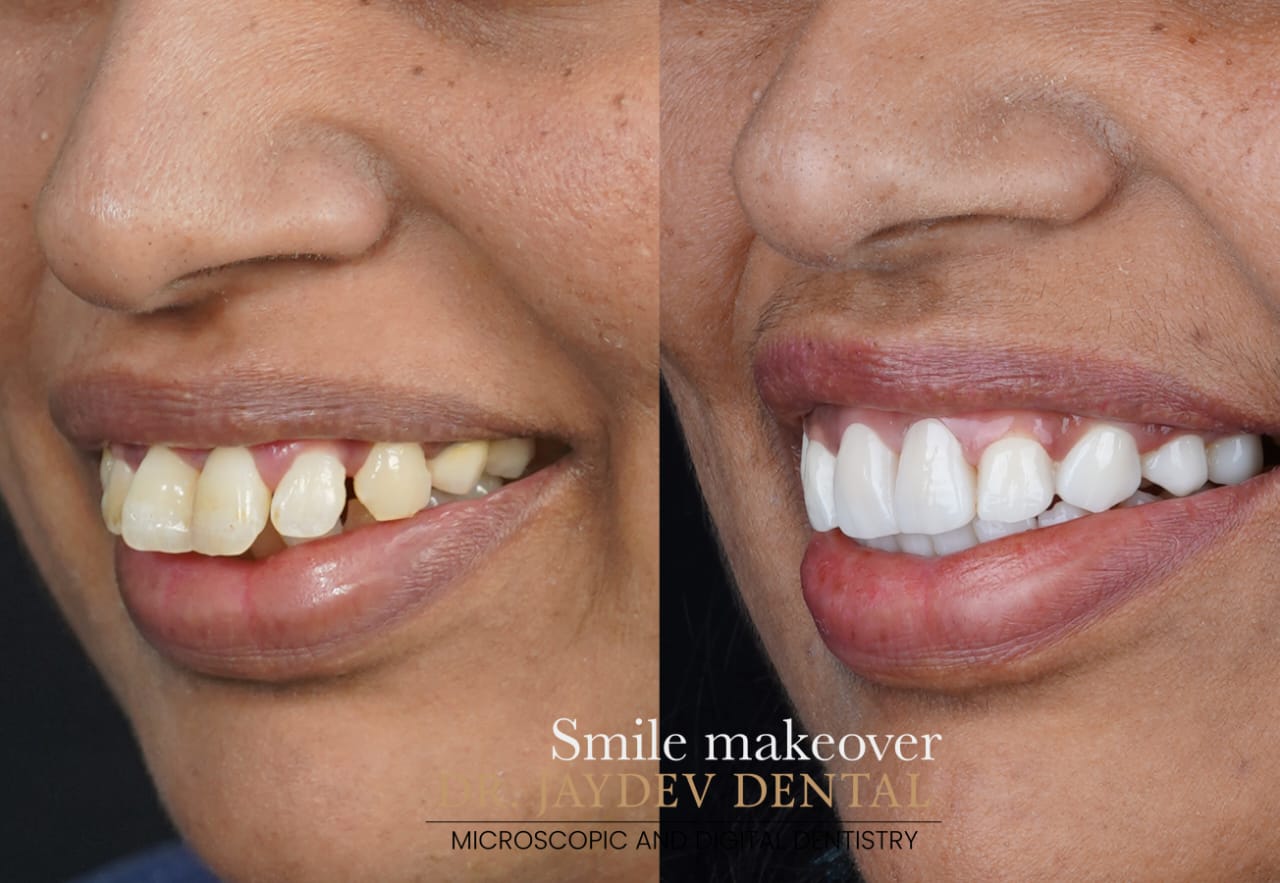 Smile Makeover